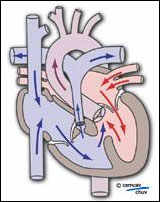 Schéma la physio-pathologie d'une tétralogie de fallot