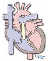 Schéma d'un traitement chirurgical d'une tétralogie de fallot