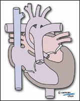 Schéma illustrant l'hypoplasie du ventricule gauche