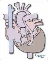 Schéma illustrant le résultat de la correction chirurgicale d'une hypoplasie VG