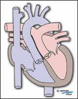 Schéma d'une transposition des gros vaissaux
