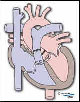 Traitement chirurgical d'une TGV