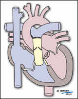 Traitement chirurgical d'un tronc artériel