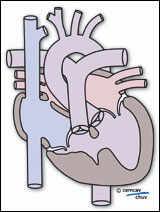 Schéma d'un coeur à ventricule unique