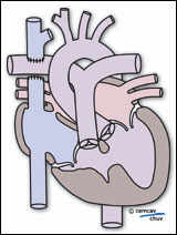 Schéma de la première phase de la correction chirurgicale d'un ventricule unique