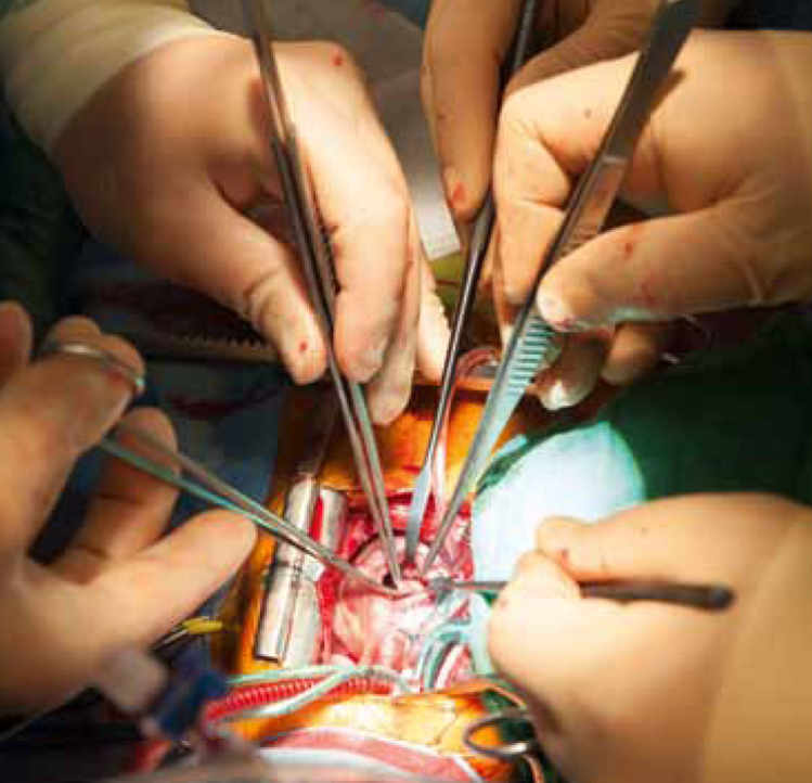 Opération du cœur d'un nourrisson