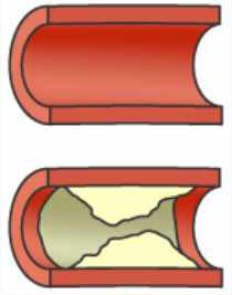 Progression de l’athérosclérose coronarienne