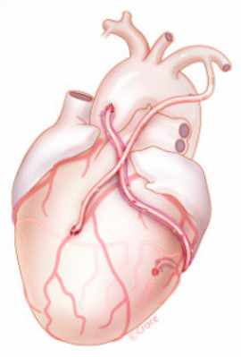 Figure 2 : Exemple de pontage aorto-coronarien