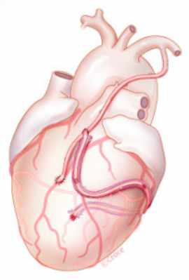 Figure 3 : Exemple de pontage aorto-coronarien