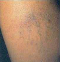 photo de varices apparentes