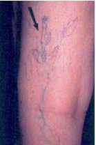 photo varices réticulaires