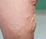 varices tronculaires