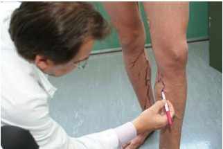 varice jambe operation