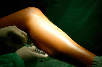 operation des varices