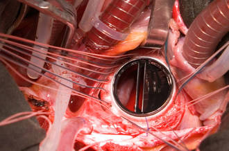 implantation d'une prothèse valvulaire