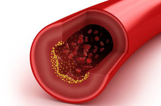 artère obstruée par du cholestérol