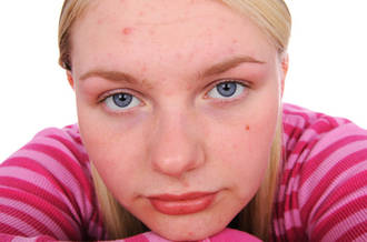 Acné: démêlons le vrai du faux