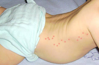 Enfant avec des taches rouges