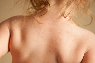Pédiatrie: le point sur les problèmes dermatologiques courants