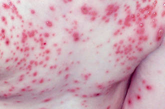 varicelle