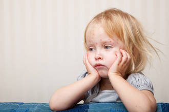 Fillette ayant la varicelle