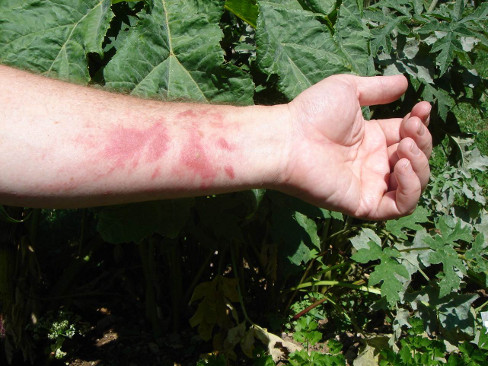 Allergies: quand la peau réagit aux plantes - Planete sante