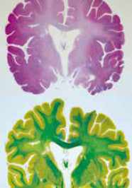 Couleurs spécifiques pour lésions différentes.