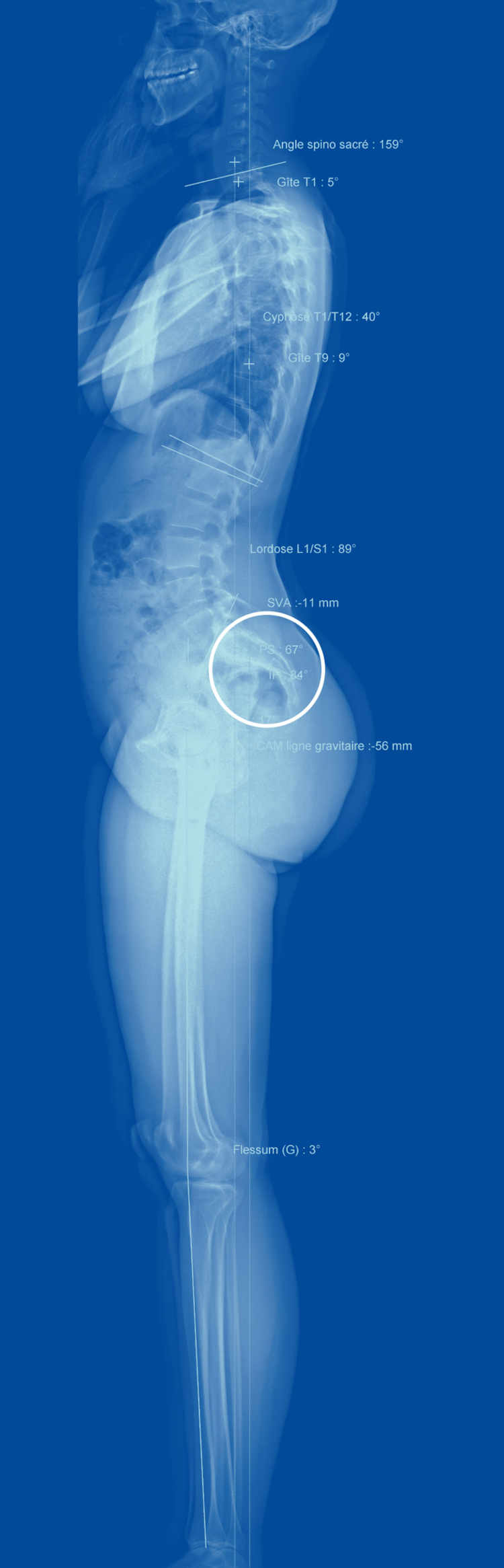 Prise en position debout, cette image montre que le sacrum de cette personne débute presque à l'horizontale. L'extrême cambrure de la patiente est la source de ses maux de dos invalidants.