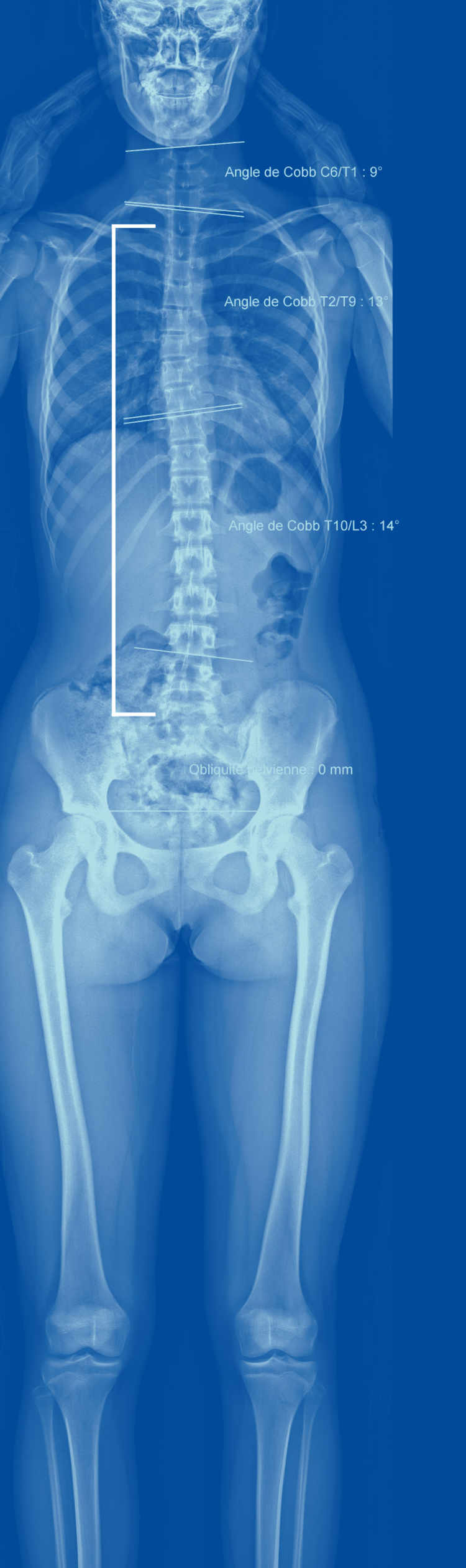On voit sur cette image une légère scoliose chez une personne jeune. Des images de radiographie permettent un suivi régulier de cette affection.
