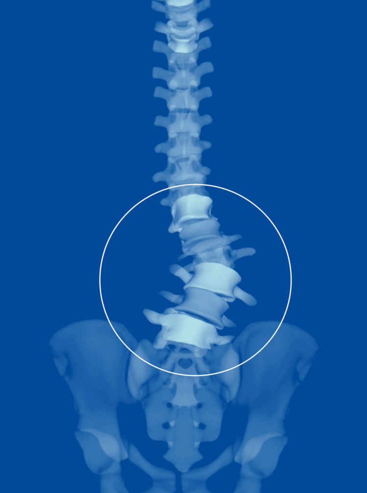 Grâce à une reconstitution en 3D de la colonne, on voit ici une forte scoliose (colonne vertébrale anormalement incurvée) qui cause au patient des douleurs dans le bas du dos.