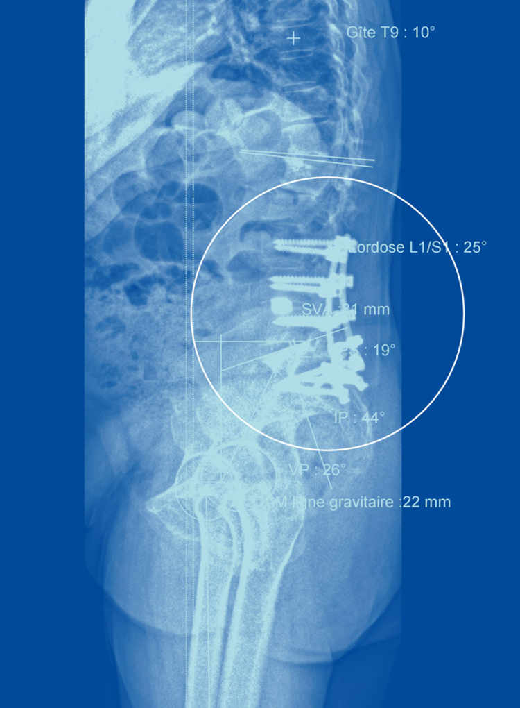 Les radiographies sont aussi utiles pour évaluer la réussite d'une opération du dos. Cette personne a un dos très plat et il a fallu la réopérer pour modifier sa cambrure, et donc son centre de gravité.