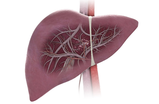 Cirrhose Planete Sante