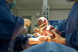 Césarienne: il faut savoir faire la part du vrai et du faux