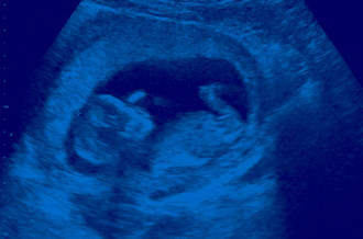 Les enjeux du diagnostic préimplantatoire