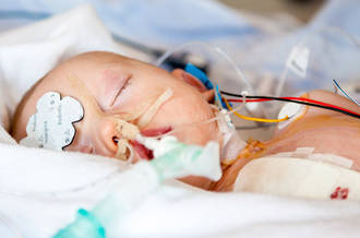 Des chirurgiens suisses sont parvenus à séparer deux sœurs siamoises nées prématurément