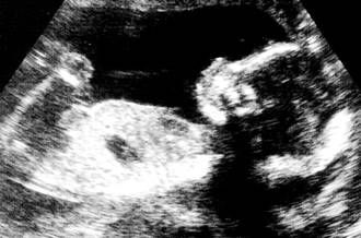 Les avancées de la thérapie fœtale