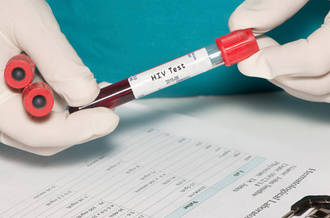 Une forme agressive de VIH découverte à Cuba