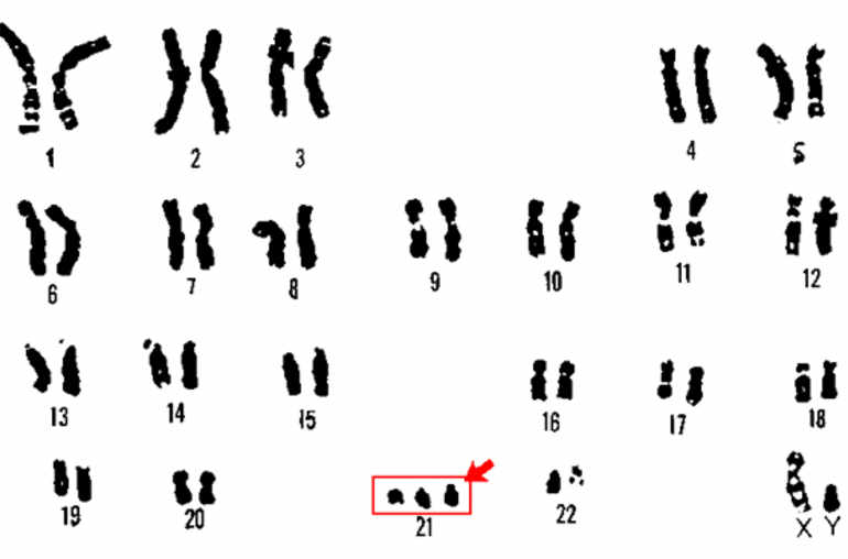 Caryotype d'un garçon atteint de trisomie 21 (syndrome de Down) – Source: U.S. Department of Energy Human Genome Program 