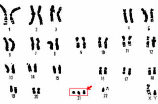 Caryotype d'un garçon atteint de trisomie 21 (syndrome de Down) – Source: U.S. Department of Energy Human Genome Program 