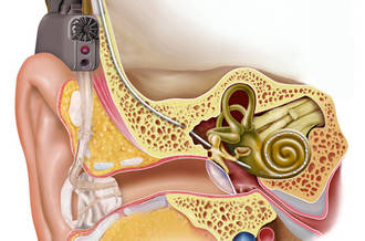 implant_cochleaire