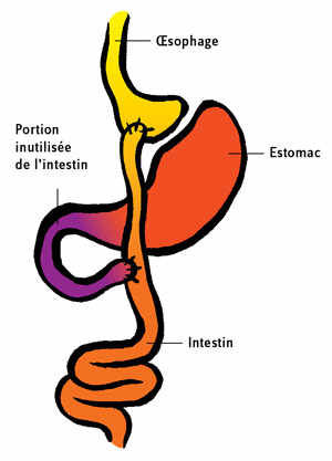 Le bypass gastrique, un court-circuit