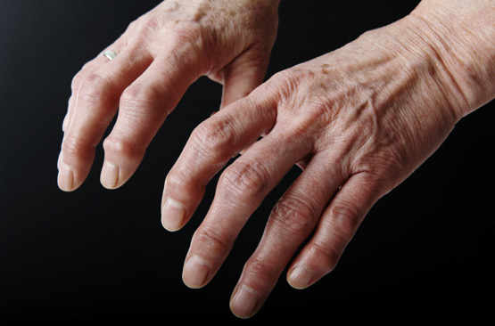 Mains atteintes d'arthrose