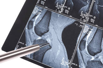 Un nouveau ligament dans le genou?