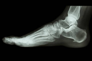Chirurgie assistée par ordinateur en orthopédie: les bénéfices sur le pied et la cheville