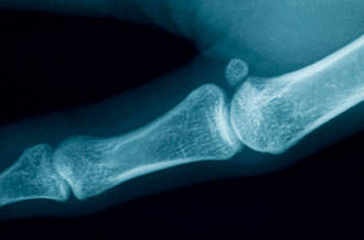 Radiographie d'ostéoporose