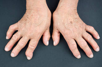 La polyarthrite rhumatoïde en quelques mots