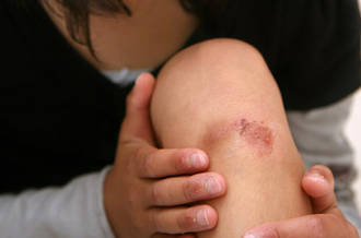 J'ai facilement des bleus