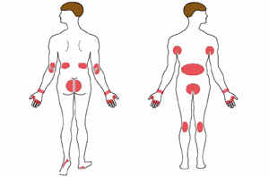 Endroits privilégiés pour avoir de la gale