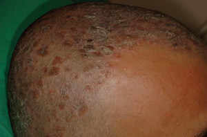 Psoriasis du scalp
