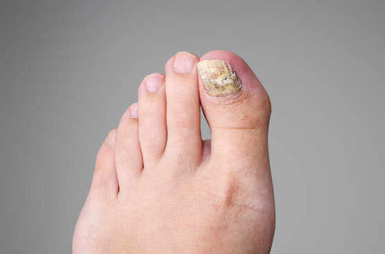 Mycoses des ongles: un diagnostic précis est nécessaire pour garantir la guérison